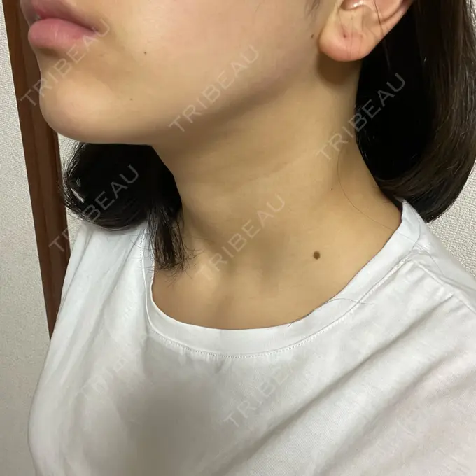 ボトックス（エラ・小顔） ルラ美容クリニック 大阪本院 AFTER メイン用