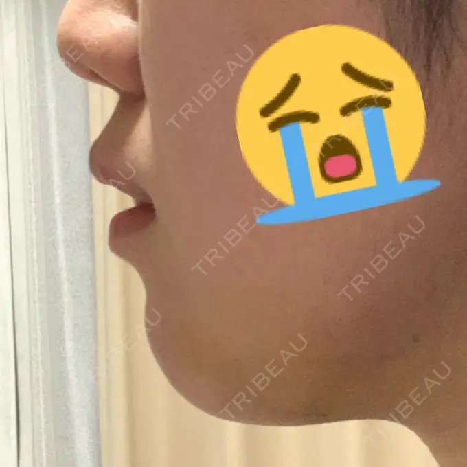 あごプロテーゼ / ヒアルロン酸注入（鼻） WOM CLINIC GINZA （ワム クリニック ギンザ） DAY 3 メイン用