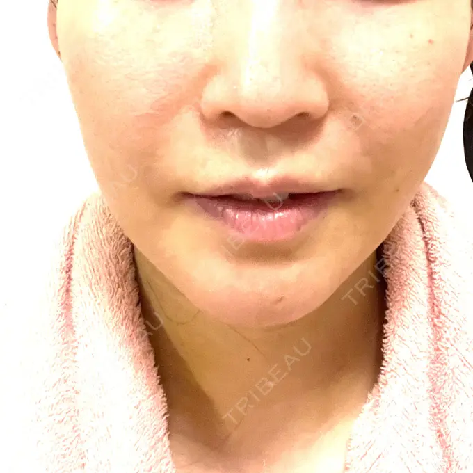 糸リフト / 脂肪吸引（顔） / ヒアルロン酸注入（額） 東京ミッドクリニック DAY 11 メイン用