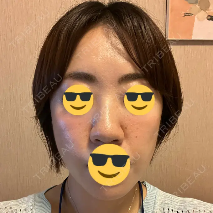 糸リフト / ボトックス（エラ・小顔） / 脂肪溶解注射（顔） X CLINIC 福岡天神院 DAY 3 メイン用