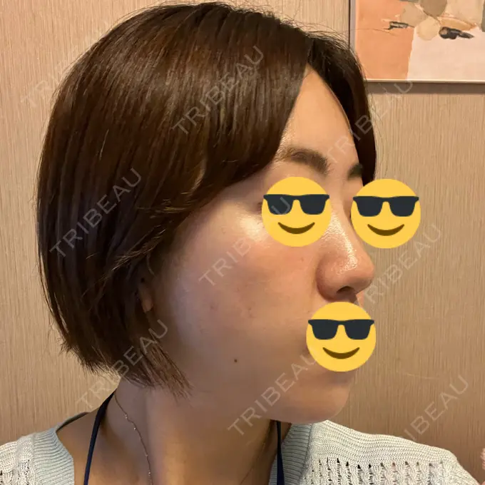 糸リフト / ボトックス（エラ・小顔） / 脂肪溶解注射（顔） X CLINIC 福岡天神院 DAY 3 メイン用