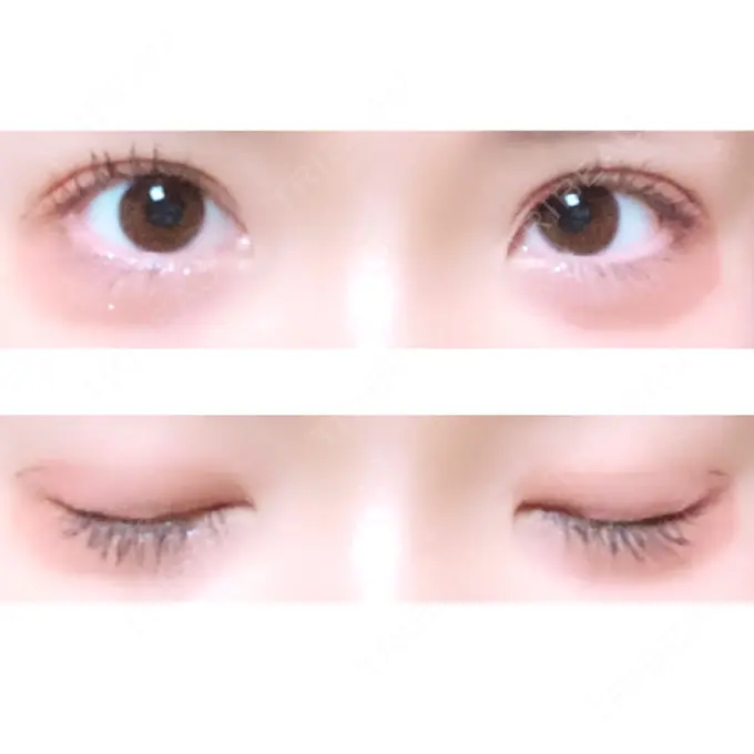 二重埋没 ハナビューティークリニック DAY 122 メイン用