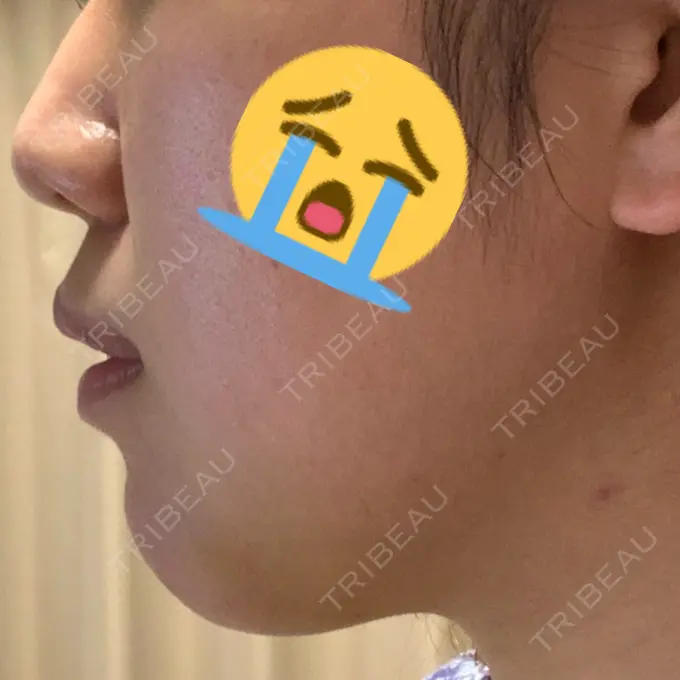 あごプロテーゼ / ヒアルロン酸注入（鼻） WOM CLINIC GINZA （ワム クリニック ギンザ） DAY 4 メイン用