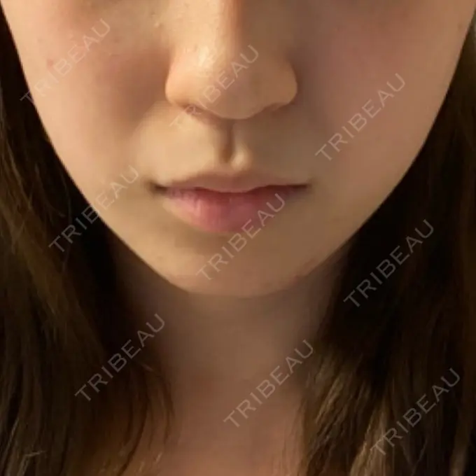 ボトックス（エラ・小顔） TCB東京中央美容外科 池袋駅前院 AFTER メイン用