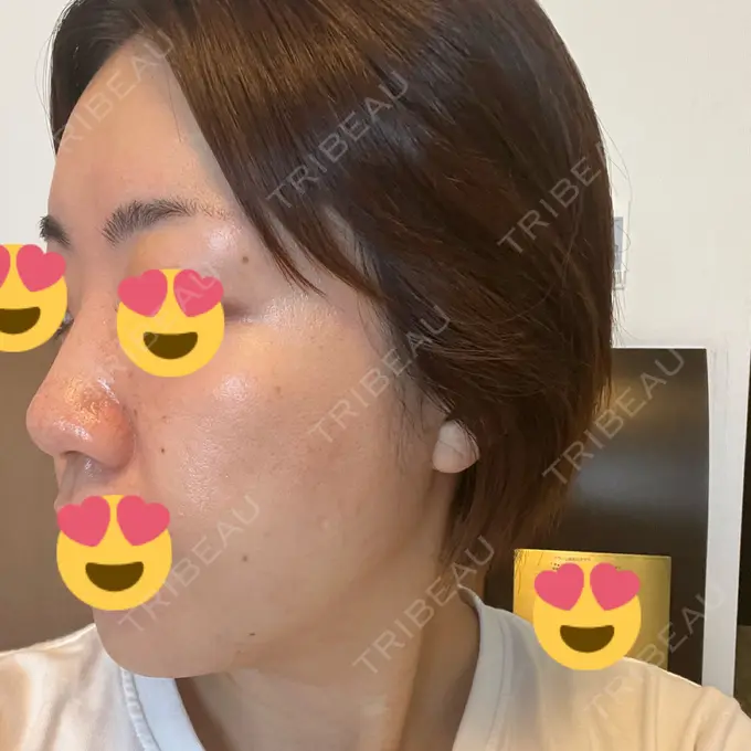 糸リフト / ボトックス（エラ・小顔） / 脂肪溶解注射（顔） X CLINIC 福岡天神院 DAY 3 メイン用