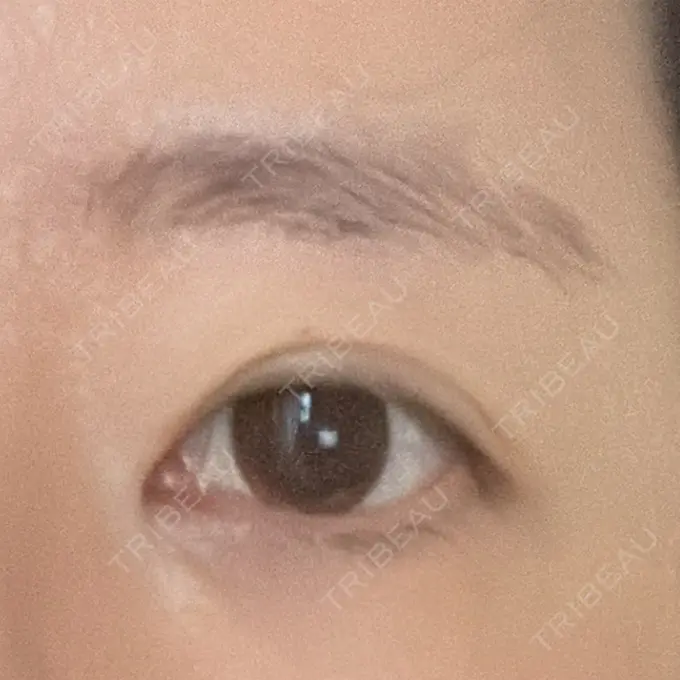 眉下切開 湘南美容クリニック 秋葉原院 AFTER メイン用