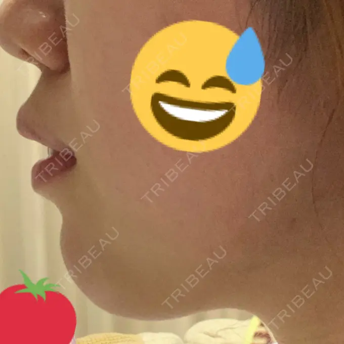 あごプロテーゼ / ヒアルロン酸注入（鼻） WOM CLINIC GINZA （ワム クリニック ギンザ） DAY 5 メイン用