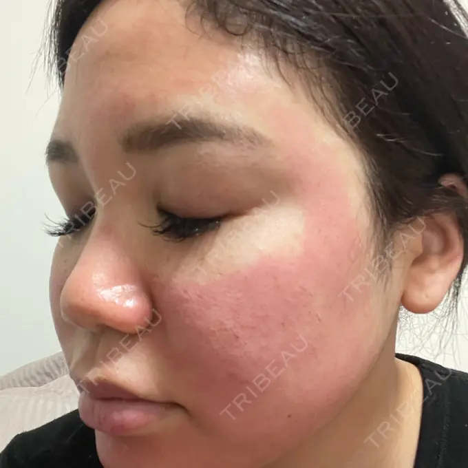 美容点滴・美容注射（美肌） / ヴェルヴェットスキン オーマイクリニック【Oh My Clinic】 DAY 0 メイン用