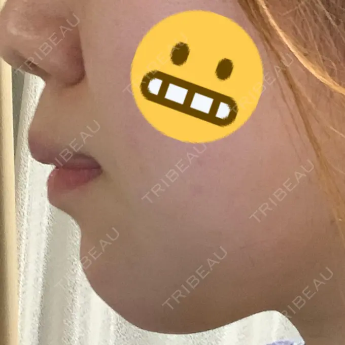 あごプロテーゼ / ヒアルロン酸注入（鼻） WOM CLINIC GINZA （ワム クリニック ギンザ） DAY 6 メイン用