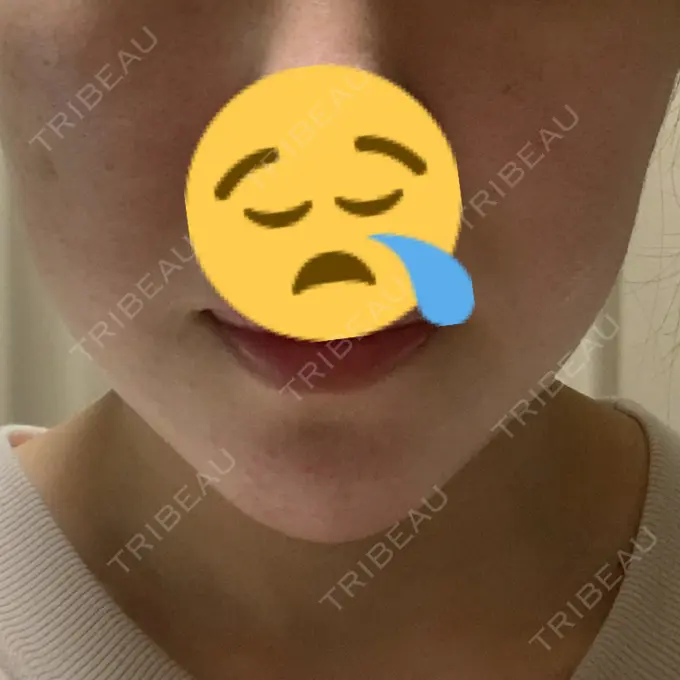 あごプロテーゼ / ヒアルロン酸注入（鼻） WOM CLINIC GINZA （ワム クリニック ギンザ） DAY 6 メイン用