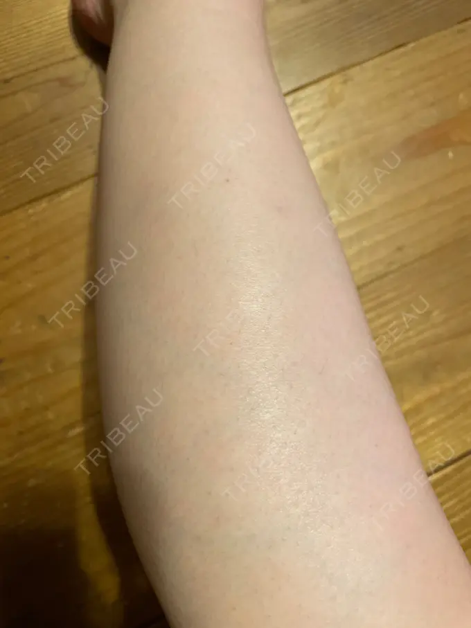 医療脱毛（全身） STARS CLINIC AFTER メイン用