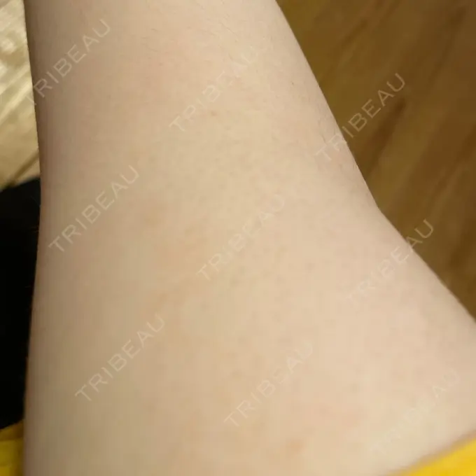 医療脱毛（全身） STARS CLINIC DAY 55 メイン用