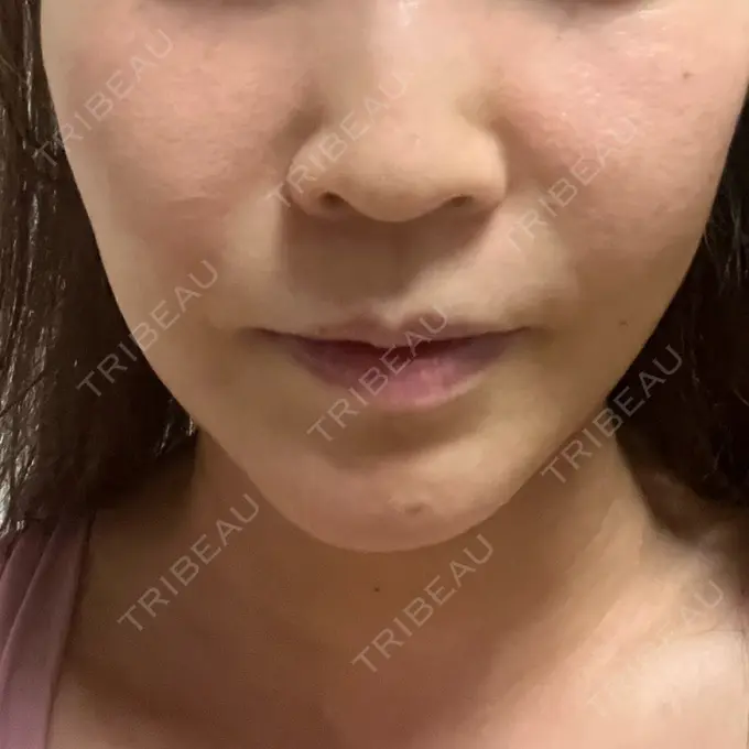 糸リフト / 脂肪吸引（顔） / ヒアルロン酸注入（額） 東京ミッドクリニック DAY 14 メイン用