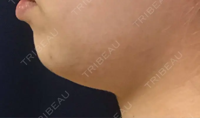 脂肪溶解注射（顔） 東京ロイヤルクリニック AFTER メイン用