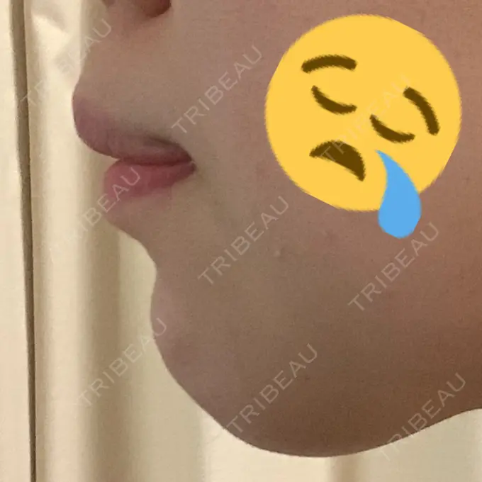 あごプロテーゼ / ヒアルロン酸注入（鼻） WOM CLINIC GINZA （ワム クリニック ギンザ） DAY 7 メイン用