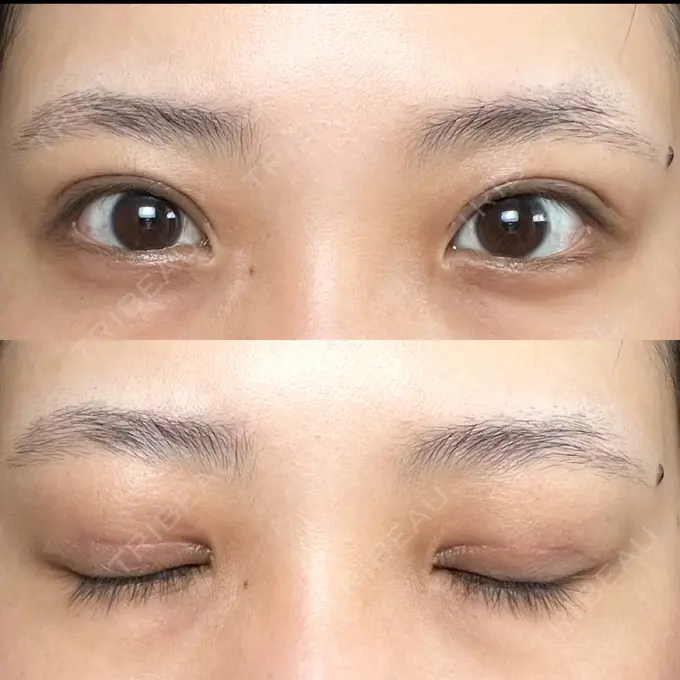 二重切開 / その他（目元） LIKI CLINIC KOBE DAY 27 メイン用