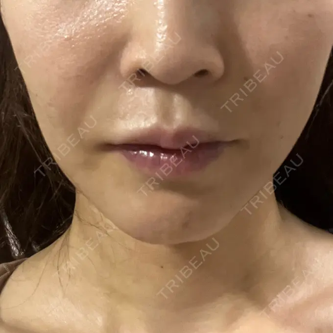 糸リフト / 脂肪吸引（顔） / ヒアルロン酸注入（額） 東京ミッドクリニック DAY 17 メイン用