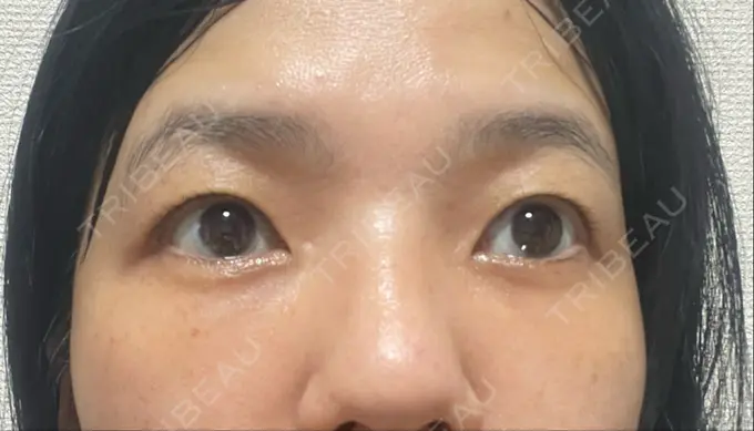 クマ治療 / 下まぶたたるみ取り セオリークリニック DAY 28 メイン用