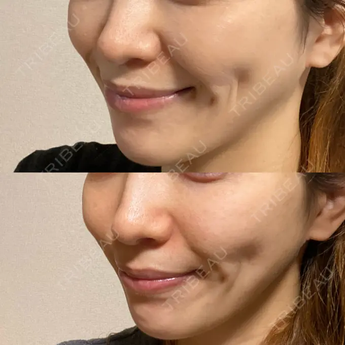 メーラーファット除去 ガーデンクリニック 名古屋院 DAY 65 メイン用