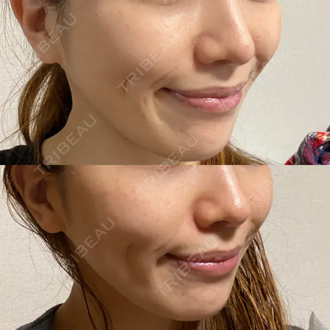 メーラーファット除去 ガーデンクリニック 名古屋院 DAY 65 メイン用