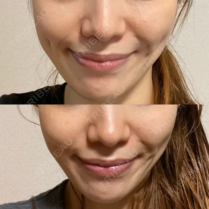 メーラーファット除去 ガーデンクリニック 名古屋院 DAY 65 メイン用