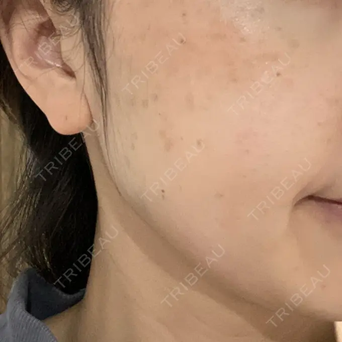 ボトックス（エラ・小顔） TCB東京中央美容外科 立川院 DAY 3 メイン用