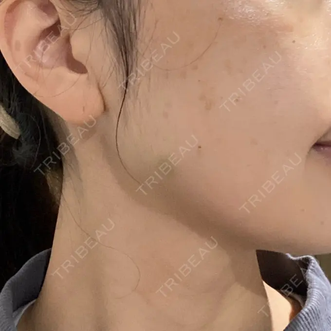 ボトックス（エラ・小顔） TCB東京中央美容外科 立川院 DAY 5 メイン用