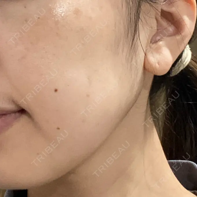 ボトックス（エラ・小顔） TCB東京中央美容外科 立川院 DAY 5 メイン用