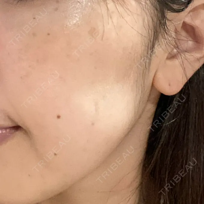 ボトックス（エラ・小顔） TCB東京中央美容外科 立川院 DAY 14 メイン用