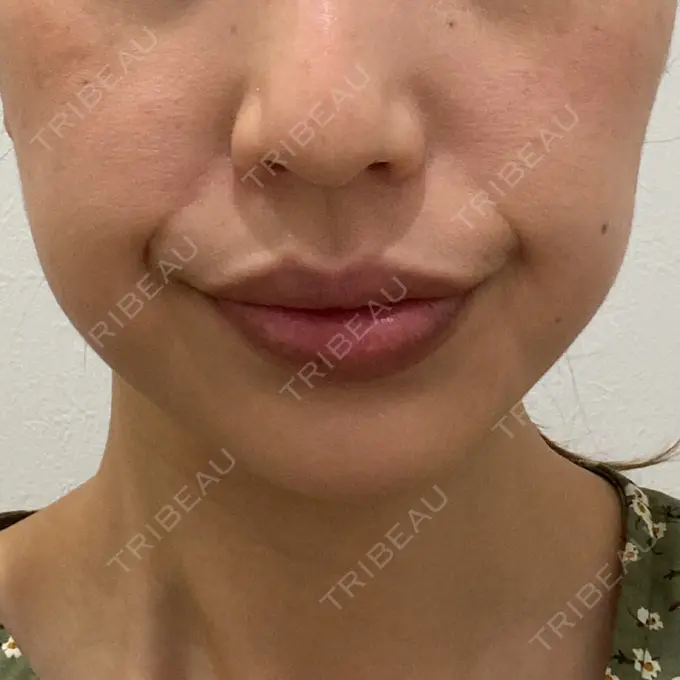 ボトックス（エラ・小顔） TCB東京中央美容外科 立川院 DAY 17 メイン用