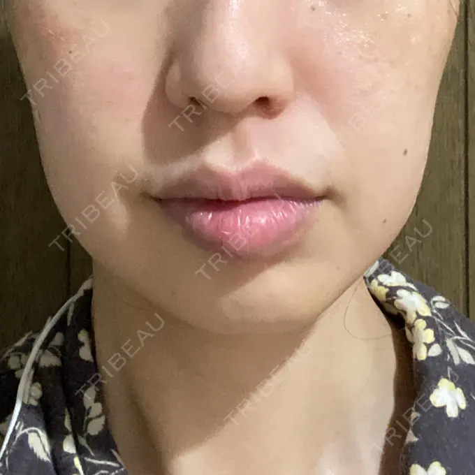 ボトックス（エラ・小顔） TCB東京中央美容外科 立川院 AFTER メイン用