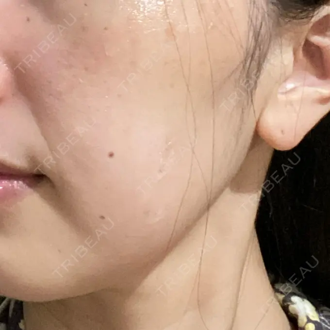 ボトックス（エラ・小顔） TCB東京中央美容外科 立川院 DAY 39 メイン用