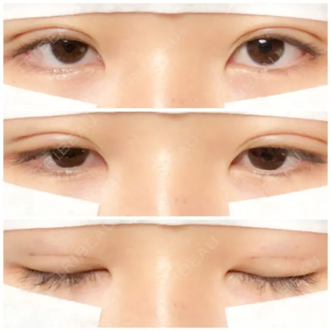 二重埋没 湘南美容クリニック 長野院 DAY 2 メイン用