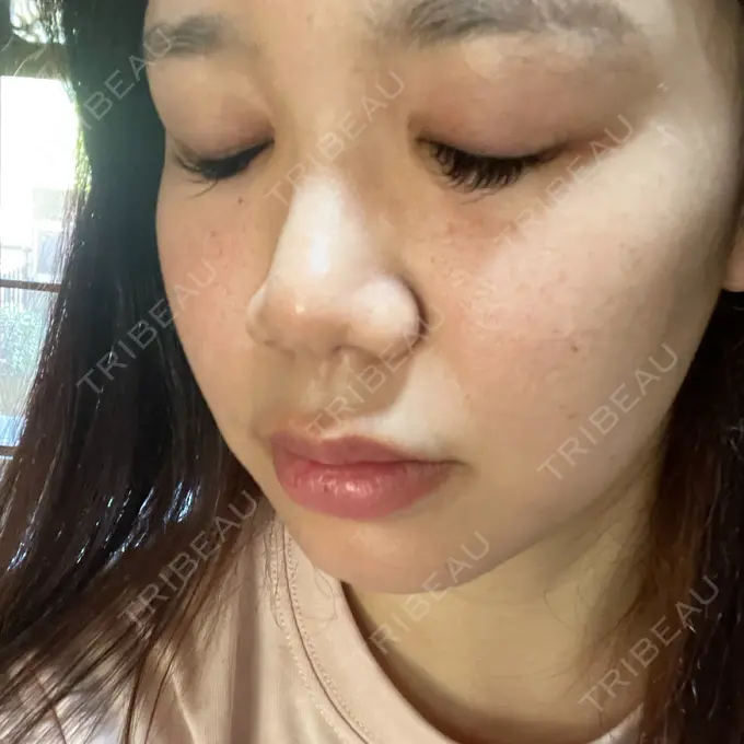 美容点滴・美容注射（美肌） / ヴェルヴェットスキン オーマイクリニック【Oh My Clinic】 AFTER メイン用