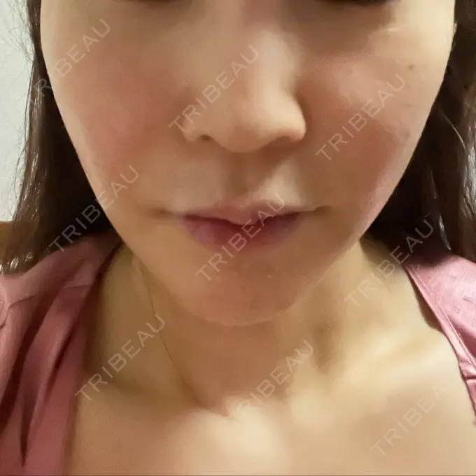 糸リフト / 脂肪吸引（顔） / ヒアルロン酸注入（額） 東京ミッドクリニック DAY 20 メイン用