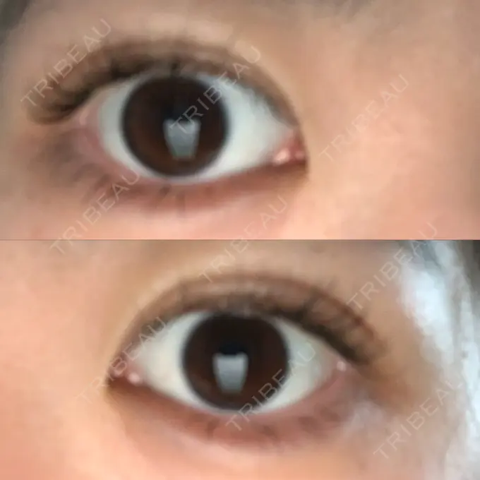 二重埋没 城本クリニック 姫路院 DAY 2 メイン用