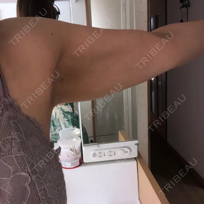 脂肪溶解注射（二の腕） ルラ美容クリニック 千葉院 / ルラスキンクリニック 千葉院 AFTER メイン用