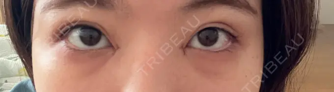 目頭切開 TCB東京中央美容外科 岡山院 DAY 2 メイン用