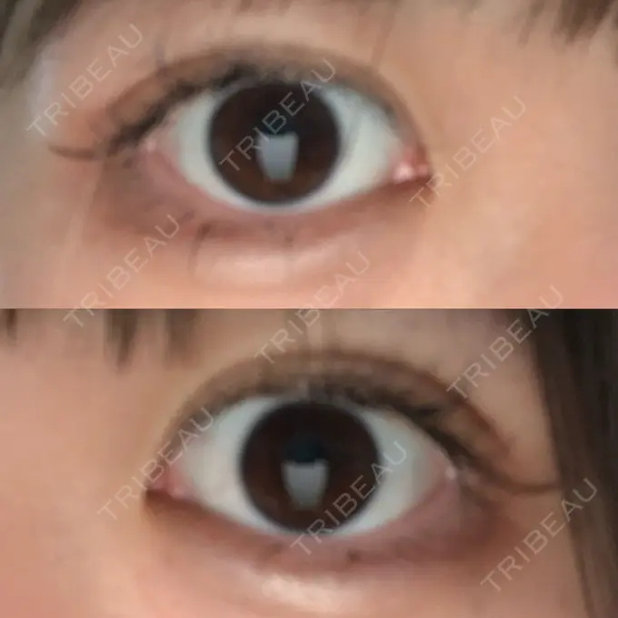 二重埋没 城本クリニック 姫路院 DAY 3 メイン用