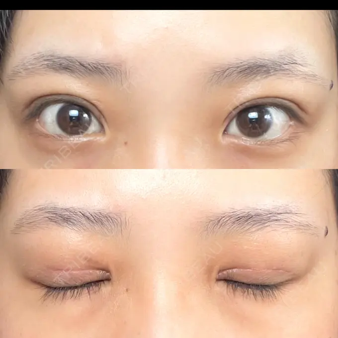 二重切開 / その他（目元） LIKI CLINIC KOBE DAY 32 メイン用