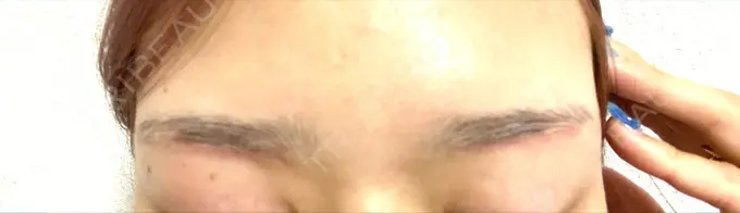 上まぶたの脂肪取り / 眉下切開 e:Top clinic（イートップクリニック） DAY 12 メイン用