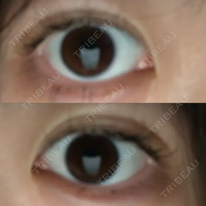 二重埋没 城本クリニック 姫路院 DAY 4 メイン用