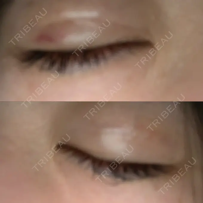 二重埋没 城本クリニック 姫路院 DAY 4 メイン用