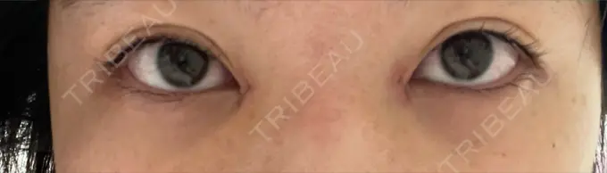 目頭切開 TCB東京中央美容外科 岡山院 DAY 3 メイン用