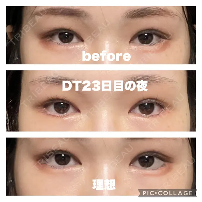 タレ目形成・グラマラスライン（切開） / 目元修正 銀座マイアミ美容外科 DAY 23 メイン用