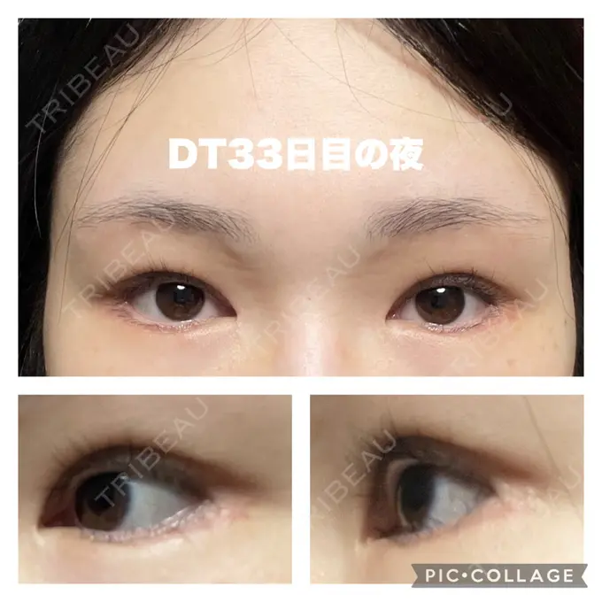 タレ目形成・グラマラスライン（切開） / 目元修正 銀座マイアミ美容外科 DAY 33 メイン用