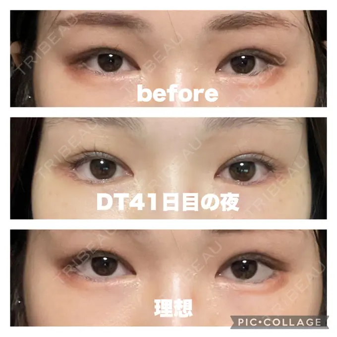 タレ目形成・グラマラスライン（切開） / 目元修正 銀座マイアミ美容外科 DAY 42 メイン用