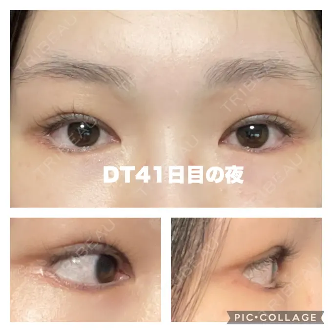 タレ目形成・グラマラスライン（切開） / 目元修正 銀座マイアミ美容外科 DAY 42 メイン用