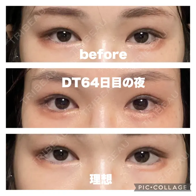 タレ目形成・グラマラスライン（切開） / 目元修正 銀座マイアミ美容外科 DAY 65 メイン用