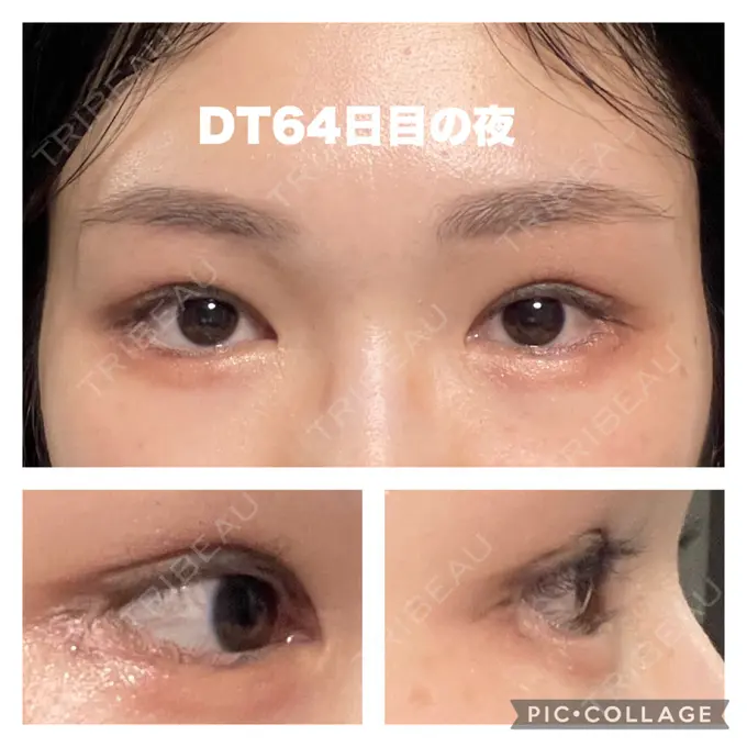 タレ目形成・グラマラスライン（切開） / 目元修正 銀座マイアミ美容外科 DAY 65 メイン用